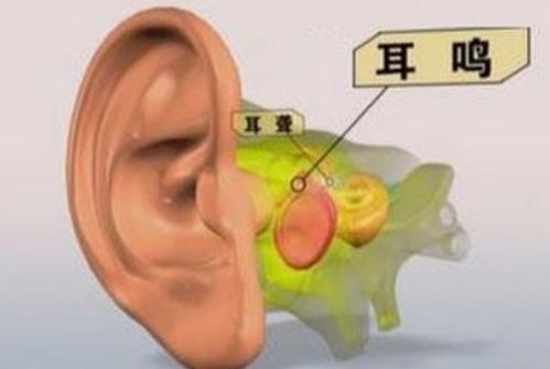 耳朵耳鸣、听不清，戴上助听器能改善吗？